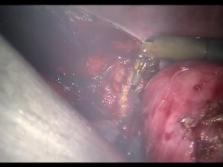 2-Port Laparoscopic Hysterectomy