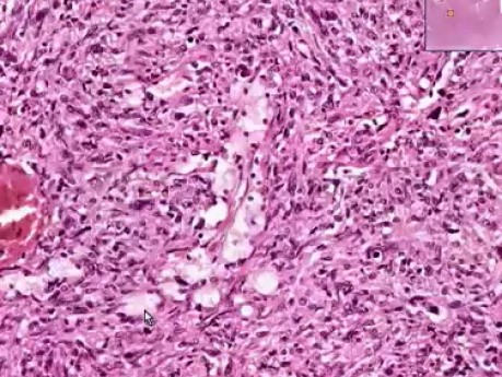 Metastatic liposarcoma - Histopathology - Diaphragm