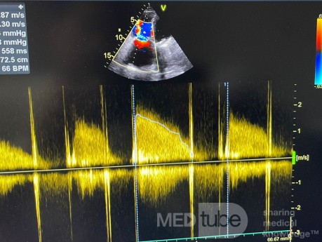Severe Tricuspid Stenosis
