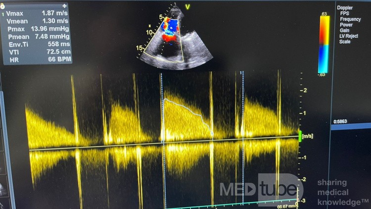 Severe Tricuspid Stenosis