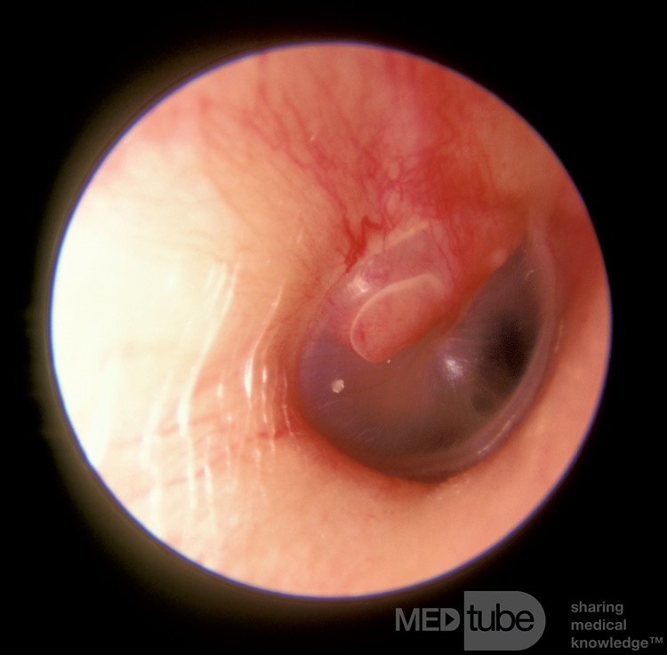 Glomus Tympanicum on Chorda Tympani Nerve