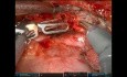 URATS Left Main Bronchus Sleeve Resection and Second Carinal Reconstruction for Carcinoid Tumor