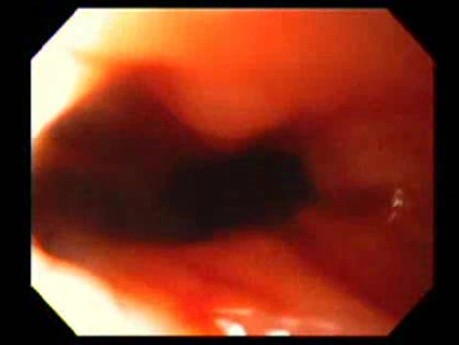 Bleeding Due to Dieulafoy´s Lesion (1 of 8)