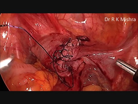 Laparoscopic Myomectomy + Ovarian Cystectomy + Cholecystectomy in Same Patient