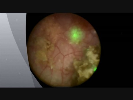Holmium Laser Lithotripsy, Stone Posterior Urethra