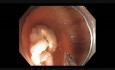 Colonoscopy Channel: Clip Closure of Post-EMR Defect In The Cecum
