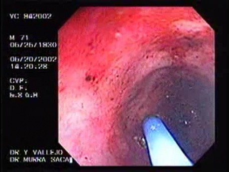Radiation Proctosigmoiditis (6 of 14)