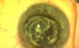 Fugo Plasma Blade Ablation Capsulotomy - Nanotechnology in Cataract Surgery
