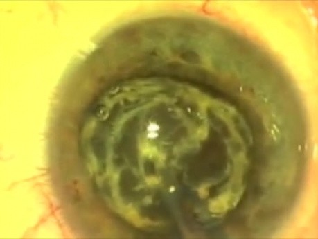 Fugo Plasma Blade Ablation Capsulotomy - Nanotechnology in Cataract Surgery
