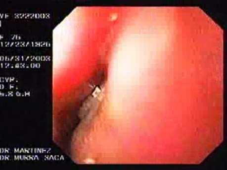 Upper Gastrointestinal Bleeding (10 of 15)