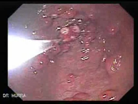 Gastric Polyposis - Endoscopy (9 of 11)