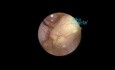 Hysteroscopic Polypectomy in a Case of Post Menopausal Bleeding 