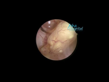 Hysteroscopic Polypectomy in a Case of Post Menopausal Bleeding 