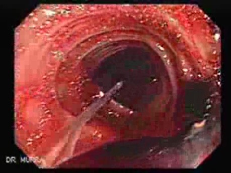 Colon Angiodysplasia (8 of 24)