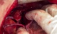 Complex Atrioventricular Groove Heart Tumor Excision
