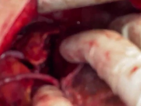 Complex Atrioventricular Groove Heart Tumor Excision