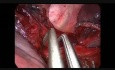 Uniportal Vats Right Lower Posterobasal Anatomic Segmentectomy (S10)