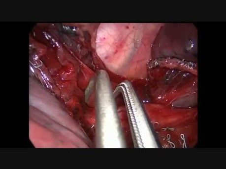 Uniportal Vats Right Lower Posterobasal Anatomic Segmentectomy (S10)