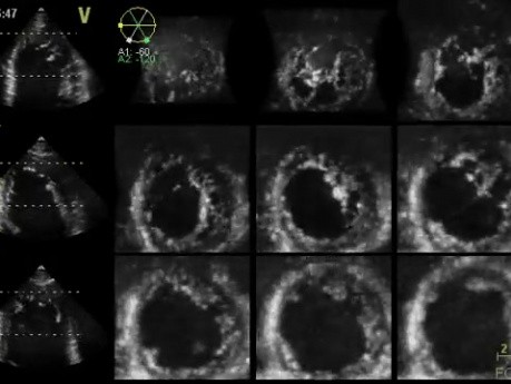 Left Ventricular Noncompaction in 3D Echocardiography, Video nr 2