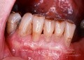 Exposed Tooth Roots