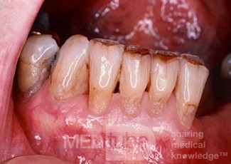 Exposed Tooth Roots