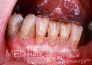 Exposed Tooth Roots