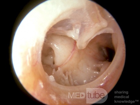 Subtotal Perforation Demonstrating Eustachian Tube Orifice