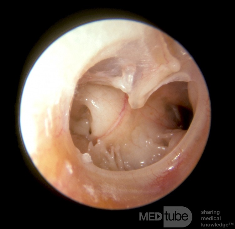 Subtotal Perforation Demonstrating Eustachian Tube Orifice