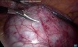 Ovarian Cyst Post Hysterectomy