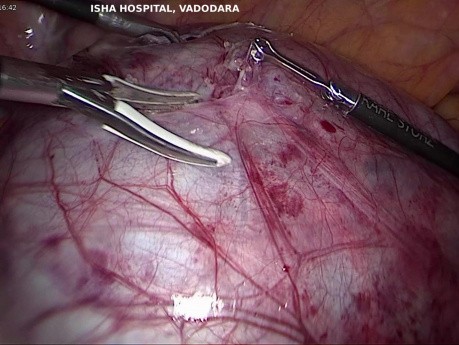 Ovarian Cyst Post Hysterectomy