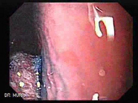 Hyperplastic Polyps - Endoscopy (2 of 14)