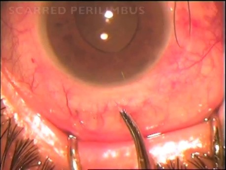 Fugo Blade Used In Glaucoma Surgery