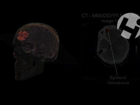 Summary of Brain Injuries