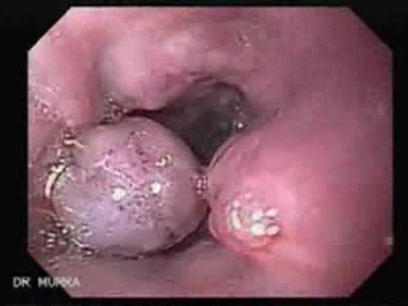 Severe Bleeding of the Upper Digestive System After Two Days of Band Ligation - Varices Post Ligation
