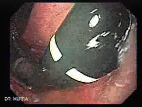 Upside-down Stomach (3 of 3)