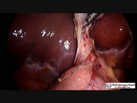 Laparoscopic Cholecystectomy Full Length Skin to Skin Video with Near Infrared Cholangiography