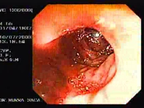 Diverticular Bleeding (3 of 4)