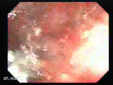 Massive Rectal Bleeding (10 of 11)