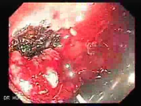 Tubulo - Villous Rectal Adenoma - Endoscopy (16 of 35)