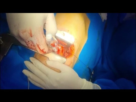 Permanent Epicardial Pace Maker Insertion and LV Size Reduction With Mesh 