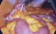 Right hemicolectomy + laparoscopic cholecystectomy (Lap chole)