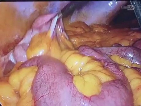 Right hemicolectomy + laparoscopic cholecystectomy (Lap chole)