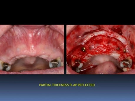 Maxillary Anterior Teeth Replacement With Implant Crowns