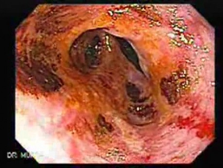 Lugol Staining Of Esophageal And Gastric Mucosa - Endoscopy