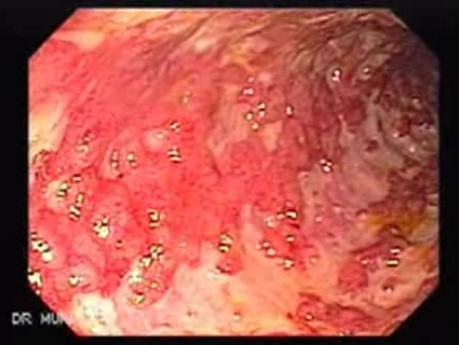 Multiple Rectal Ulcers (12 of 110)