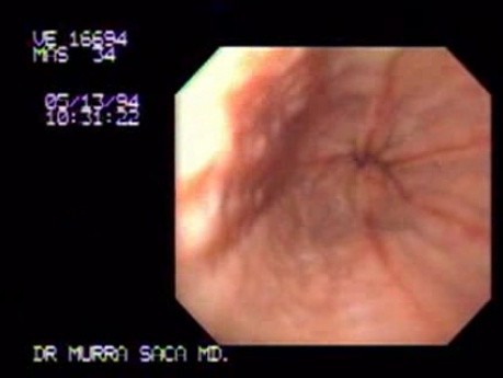 Reflux Esophagitis - Radial Ulcers