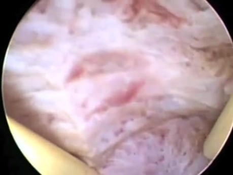 Histeroscopic endometrial ablation