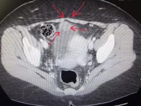 Lap Partial Cystectomy for Urachal Mass
