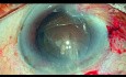 A Step by Step Approach to a Complex Case: Brown Cataract, Weak Zonules- Manual SICS & IOL Trap