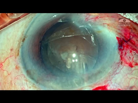 A Step by Step Approach to a Complex Case: Brown Cataract, Weak Zonules- Manual SICS & IOL Trap